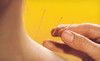 Art of Acupuncture Coupons Williston Park, New York Deals