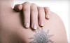 Laser Ink Removals Coupons Calgary, Alberta Deals
